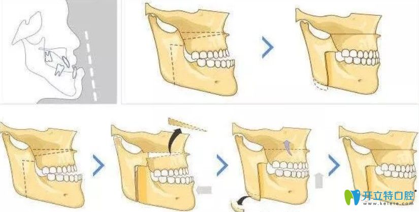 牙齿地包天会影响发音及健康