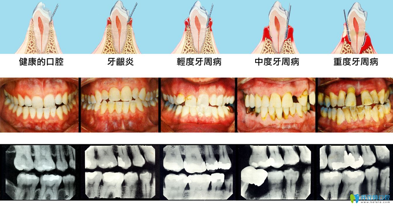牙周病发展过程