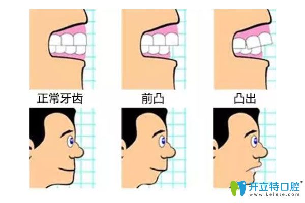 牙齿不同程度矫正后对比图