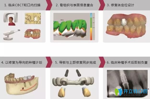 数字化导板导航种植技术过程 数字化导板导航种植技术过程