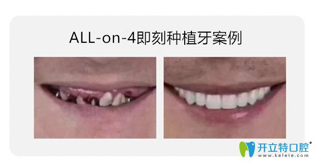 All-on-4即刻种植牙对比图片