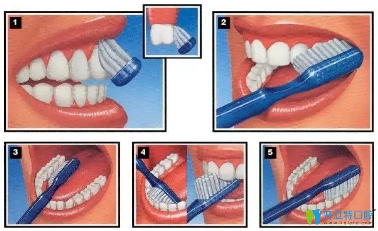 做完牙周治疗后正确的刷牙方式