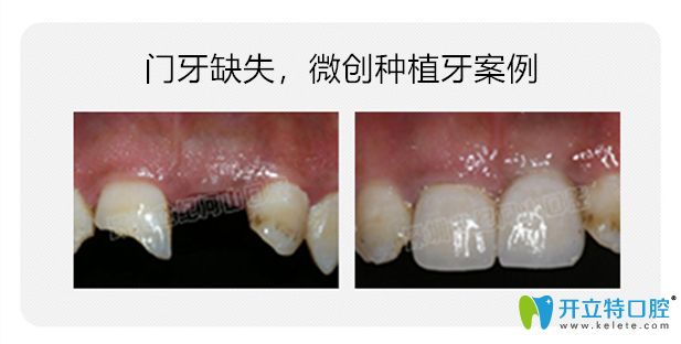 河山口腔微创种植牙案例对比图