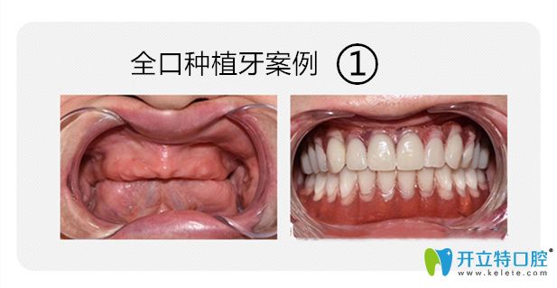 全口种植牙案例图