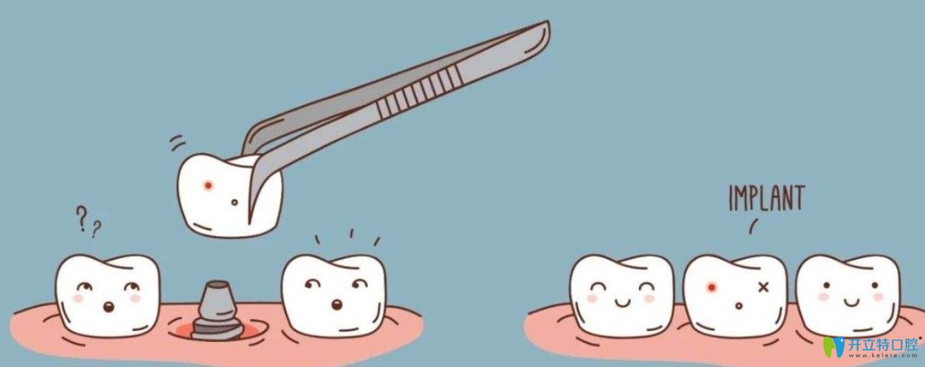 吴医生告诉大家导致牙槽骨吸收的原因有哪些