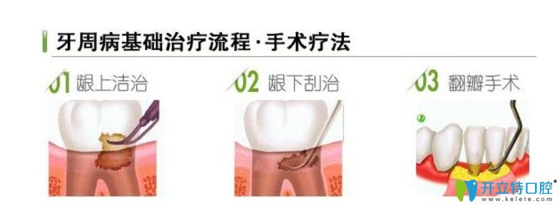 邵晨兰医生告诉大家中度牙周病的症状