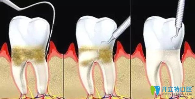 张敏医生告诉大家牙周病的治疗方法有哪些