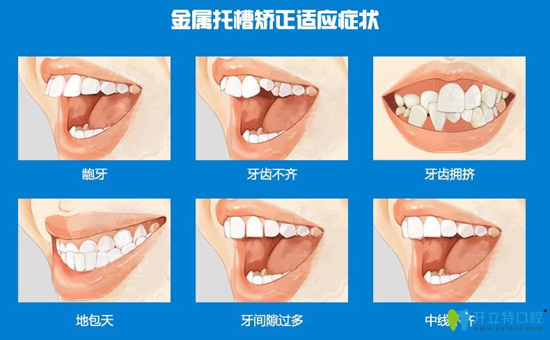 昆明雅度口腔矫正牙齿多少钱双11活动金属矫正费用4888元起