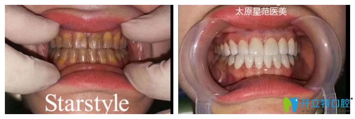 在星范做四环素牙牙贴面修复案例前后效果对比