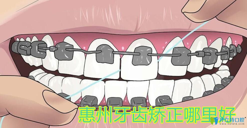 惠州哪里矫正牙齿好 惠州哪里矫正牙齿好