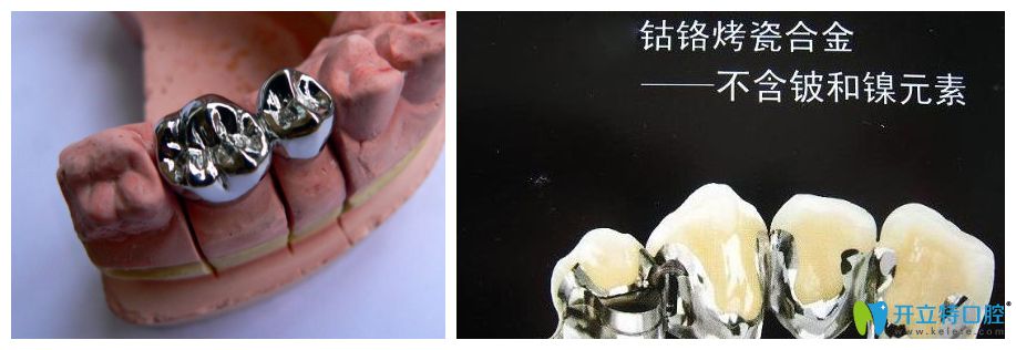 钢牙比烤瓷牙耐用吗？看烤瓷牙和钴铬钢牙的区别