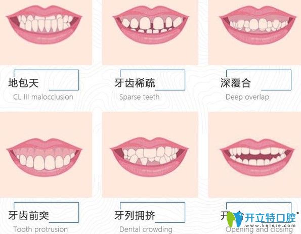 国产和进口隐形牙套的矫正效果一样