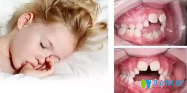 儿童牙齿畸形