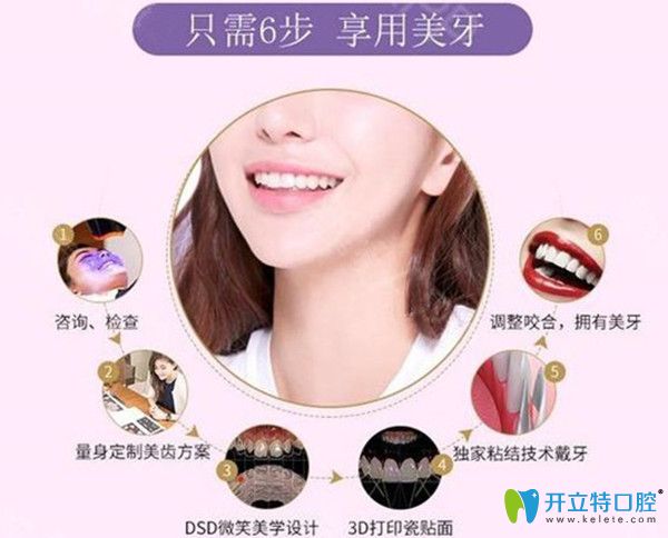 牙贴面的过程