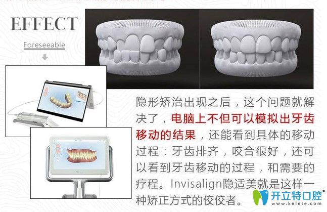 国产隐形牙套和进口的区别是什么