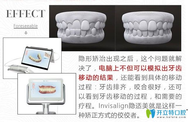 国产隐形牙套和进口的区别是什么