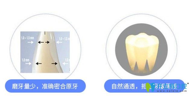 国产全瓷牙好还是进口好 国产全瓷牙好还是进口好