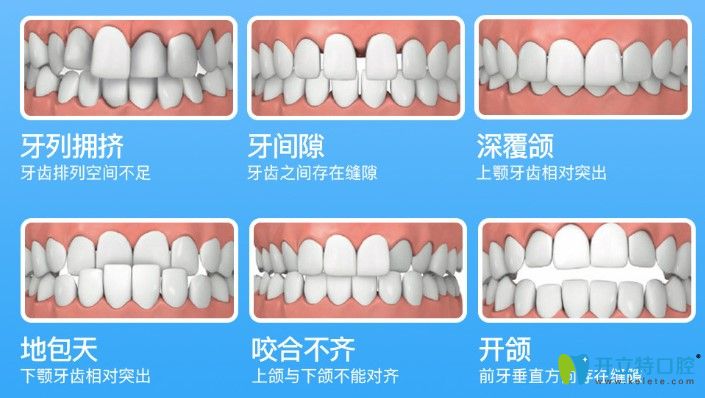 隐形牙套和钢丝牙套哪个矫正效果好