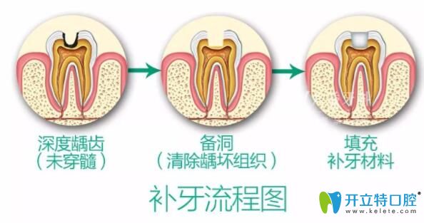 补牙过程