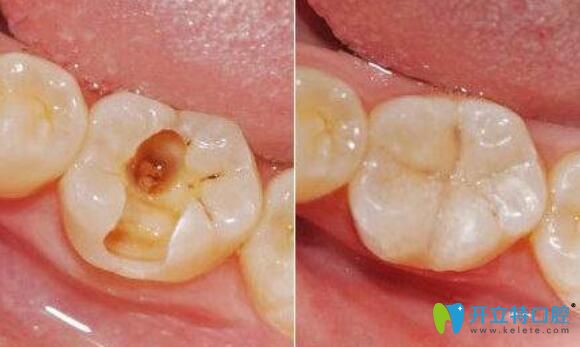首先来看看补牙和嵌体牙的区别及优缺点龋齿其实就是蛀牙,预防龋齿从