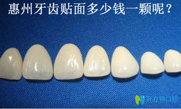关注惠州牙齿贴面多少钱时,更需了解做瓷贴面的危害和优势