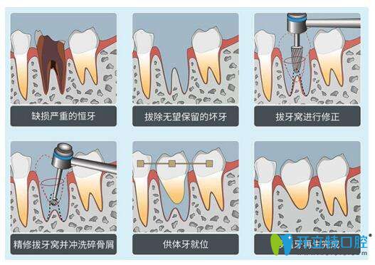 自体牙移植