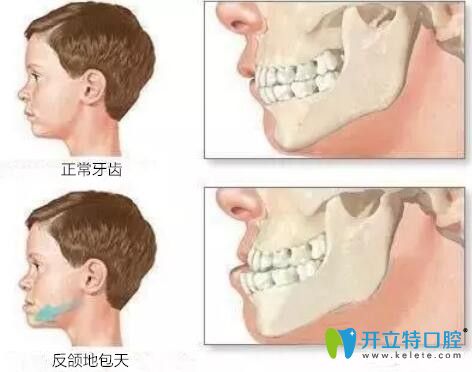 科普:儿童牙齿反颌矫正的年龄及步骤,内附反颌牙套费用