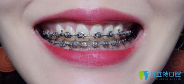 金属托槽牙齿矫正效果图