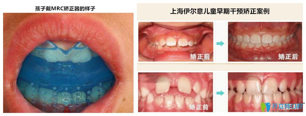孩子戴MRC的样子以及伊尔意孩子矫正的前后对比照 孩子戴MRC的样子以及伊尔意孩子矫正的前后对比照