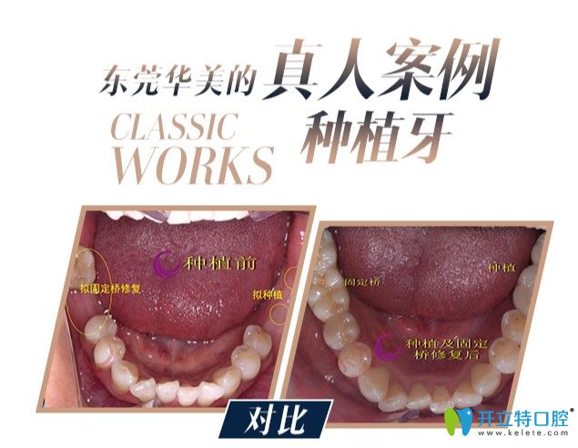 多颗牙缺失顾客在华美口腔做的种植牙案例