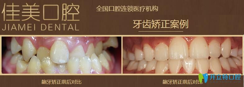 北京佳美口腔龅牙矫正案例图