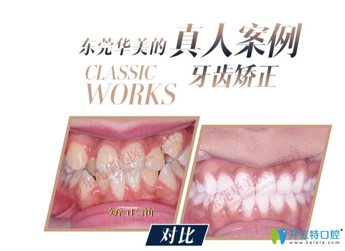 牙齿拥挤不齐的小姐姐在东莞华美口腔做完矫正前后对比图