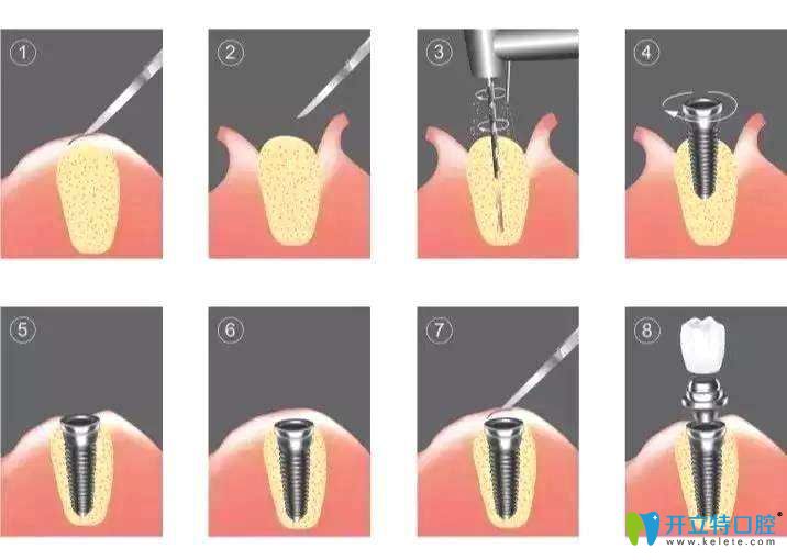 传统种植牙过程