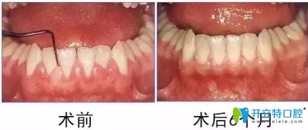 牙周炎引起的牙龈脓包治疗