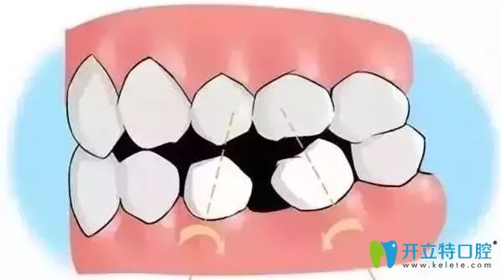 刘家威医生谈牙齿缺失不及时修复的危害