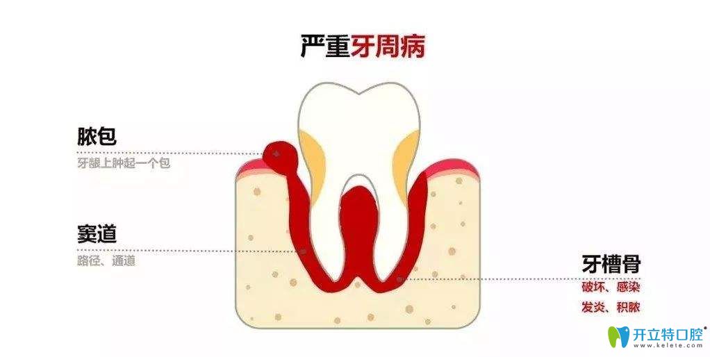 牙周炎牙龈脓包