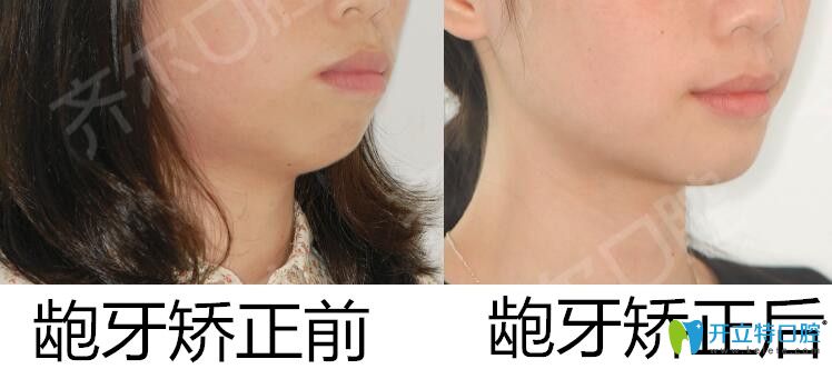 杭州齐尔口腔龅牙矫正案例 杭州齐尔口腔龅牙矫正案例
