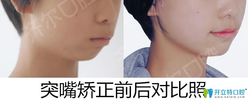 杭州齐尔口腔龅牙矫正前后对比照 杭州齐尔口腔龅牙矫正前后对比照