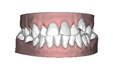 牙齿矫正的过程
