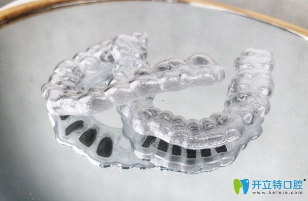 某顾客在杨国平医生这里定制的舌侧隐形矫正牙套