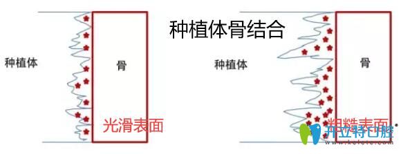 种植体与骨结合 种植体与骨结合