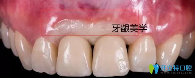 种植体牙龈美学