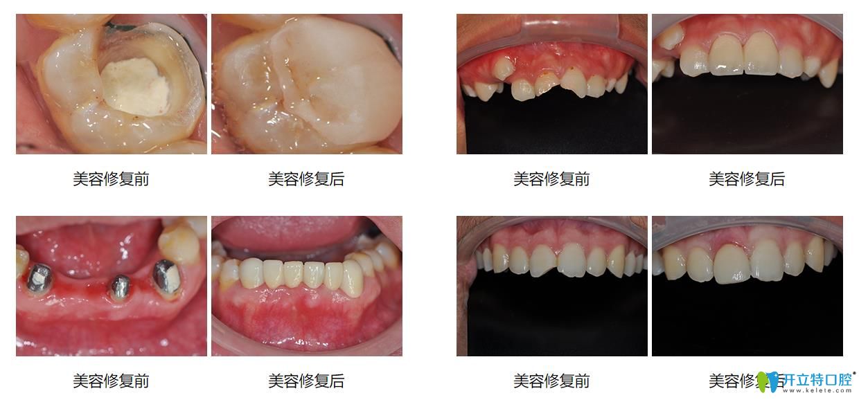 牙齿修复前后对比