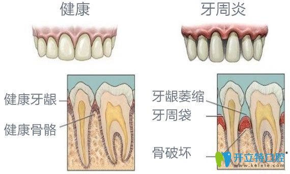 健康牙齿与牙槽骨萎缩牙齿之间对比图