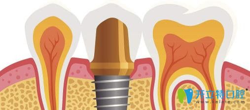 缺牙影响脸型，显老