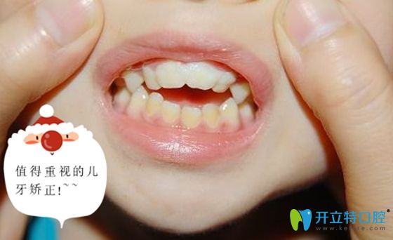儿童牙齿畸形问题值得每位家长们重视