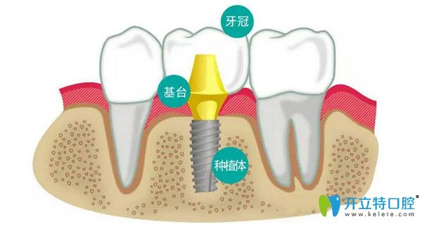 种植牙分为三大部分