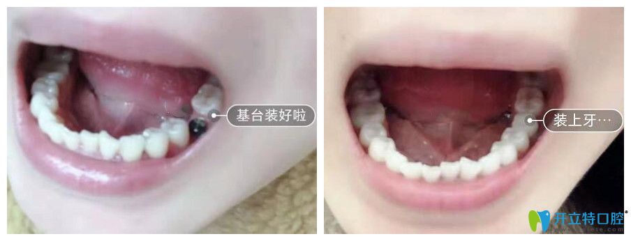 我在北京佳景爱小心口腔做即刻种牙照片