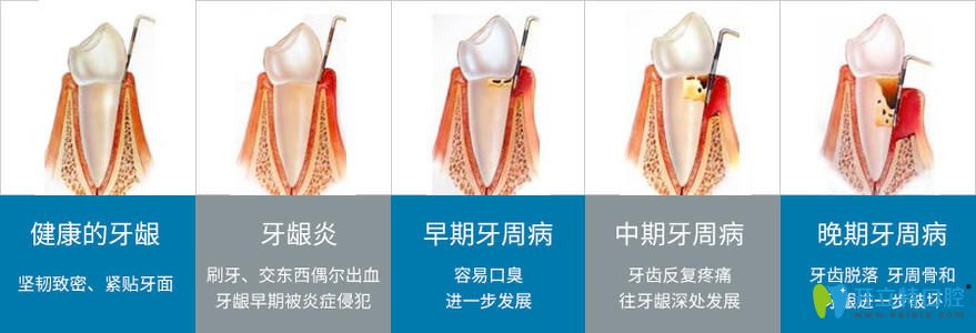 牙周疾病的发展