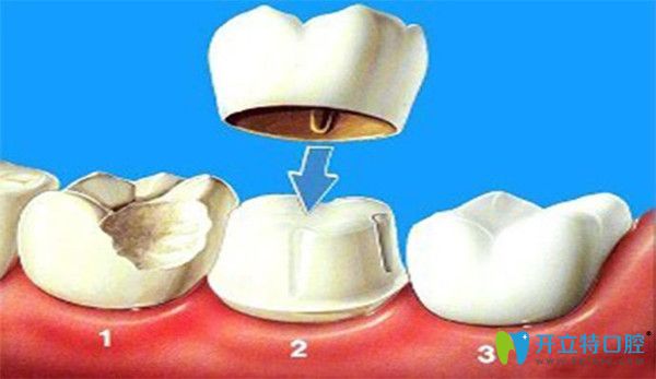 全瓷牙适合较牙体缺损的修复体